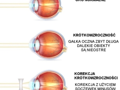 Na czym polega krótkowzroczność?